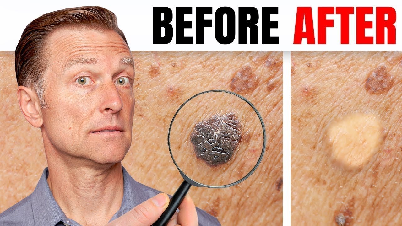 How to Remove Skin Tags and Warts Overnight Dr